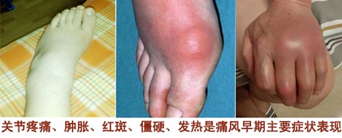 贵阳强直医院手足痛风早期主要症状.jpg