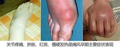 贵阳强直医院痛风早期主要症状.jpg